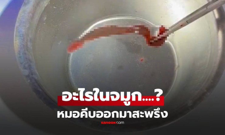 ขนลุกซู่! หนุ่มเลือดกำเดาไหล 3 วัน 3 คืน หมอคีบ ตัวเป้ง 5 ซม. ออกจากจมูก สยองยิ่งกว่าหนังผี!