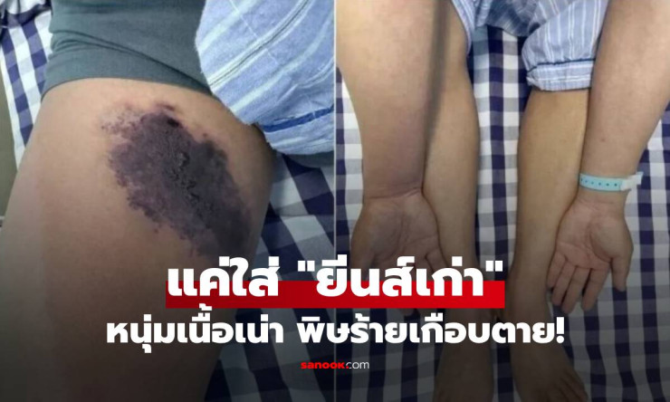 ช็อกสุดขีด! ใส่กางเกงยีนส์เก่าแป๊บเดียว เนื้อขาเน่าเปื่อยเกือบตายคาที่ พิษแมงมุมแพร่กระจายวุ่นวาย