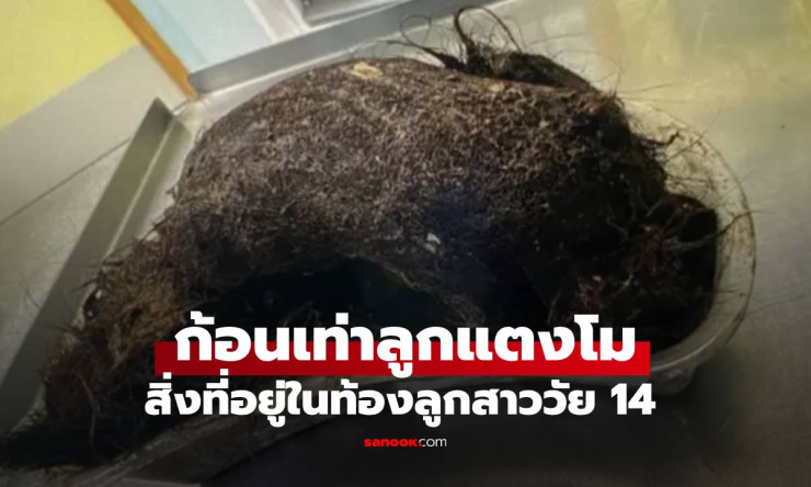 ลูกสาววัย 14 ปวดท้องครึ่งปี แม่ช็อก! หมอผ่าก้อนผมมหึมาในกระเพาะ