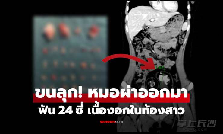 ช็อกสุดขีด! สาว 18 ผ่าท้องเจอฟัน 24 ซี่ในเนื้องอก หมออึ้งหนัก ไม่ใช่ผีไสย แต่เป็นโรคสยองแบบนี้!