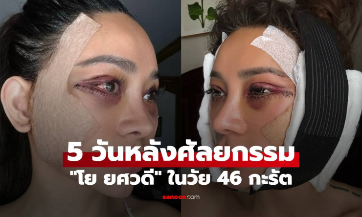 47 แล้วยังไงใครแคร์! โย ยศวดี บินเกาหลี Full Face Lift ครั้งแรก หน้าเด็กลงกว่าเดิม แค่ 5 วันแล้วเปลี