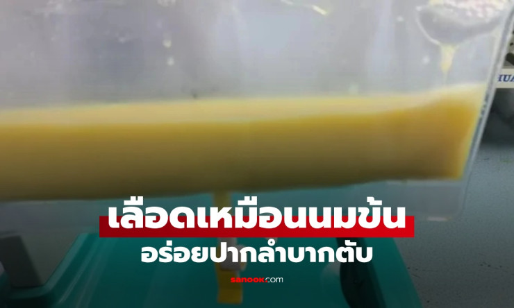 เลือดเหมือนนมข้น! หนุ่มวัย 34 เกือบตายเพราะเมนูโปรด อร่อยปากแต่ลำบากตับ