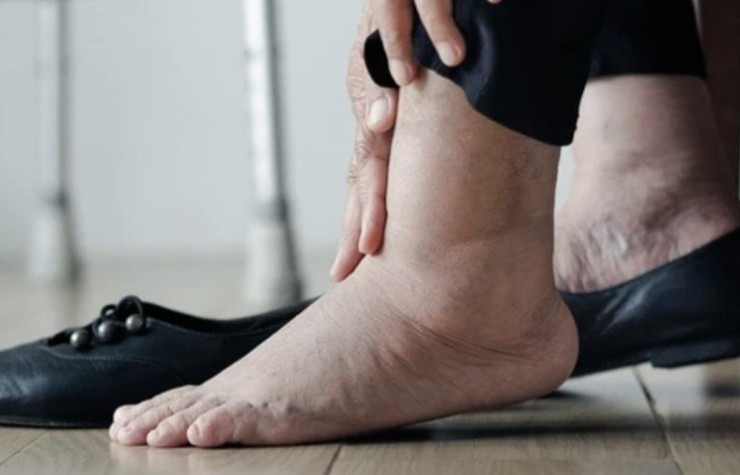 ข้อเท้าบวมเบาๆ! ร่างกายกำลังกรีดร้องเตือน ไตพัง-หัวใจวาย อย่ามองข้ามเด็ดขาด!