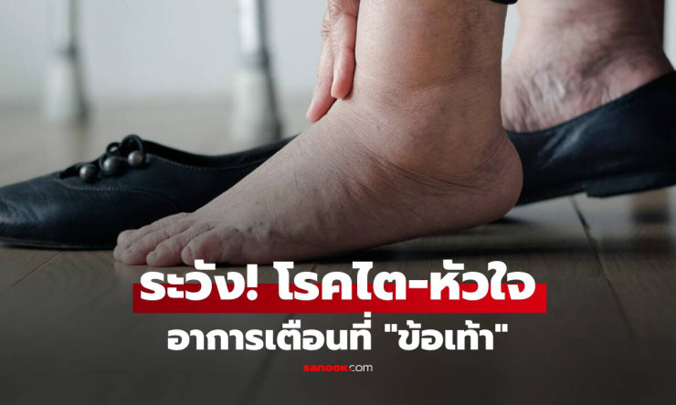 ข้อเท้าบวมแบบนี้ ระวังหัวใจ-ไตพัง! สัญญาณร้ายที่ร่างกายตะโกนเตือน ด่วนมาก!!