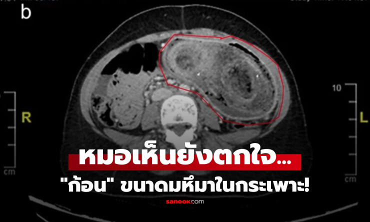 เด็กสาววัย 17 ปวดท้อง-อาเจียนไม่หยุด หมอตกใจเจอก้อนผมมหึมาในกระเพาะ!