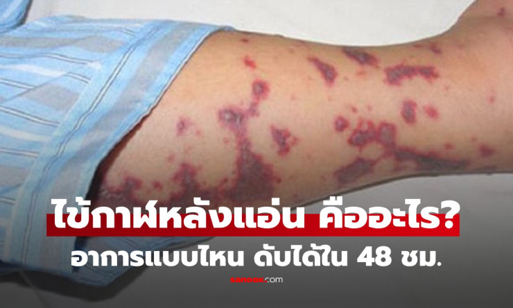 ⚠️ ไข้กาฬหลังแอ่น ฆ่าคนได้ใน 48 ชม.! ไทยเจอป่วย-ตายแล้ว รู้ทันอาการก่อนสายเกินแก้!