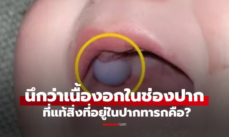 หมอตกใจคิดว่าเนื้องอกในปากทารก 9 เดือน แต่ความจริงช็อกหนัก!
