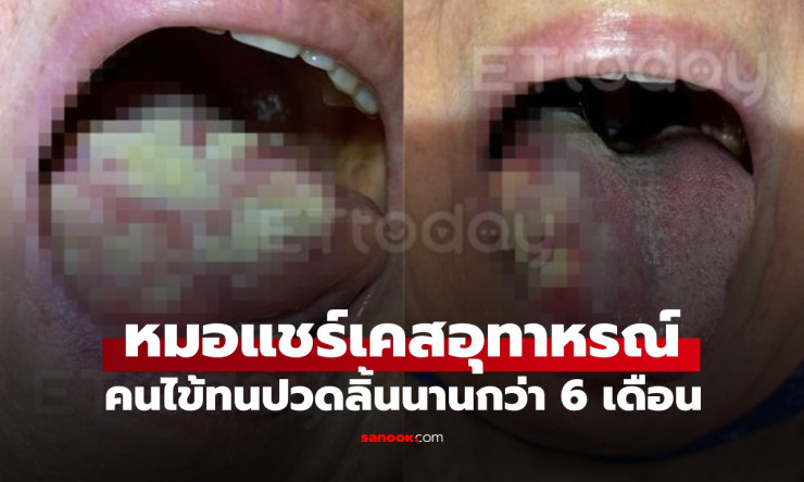 ปวดลิ้น 6 เดือนกลายเป็นมะเร็งระยะ 3! เรื่องจริงสุดสะพรึงที่หมอใจสั่น แค่เปิดปากกลิ่นโชยมา...