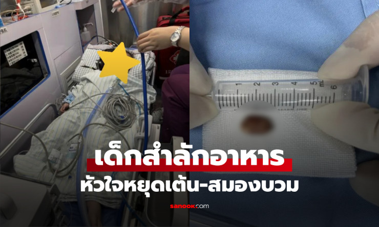 เด็ก 2 ขวบหัวใจหยุดเต้น สมองบวม! หมอเปิดปริศนา สิ่งนี้ ติดในหลอดลมเป็นสาเหตุ อุทาหรณ์สำลักอาหารที่พ่